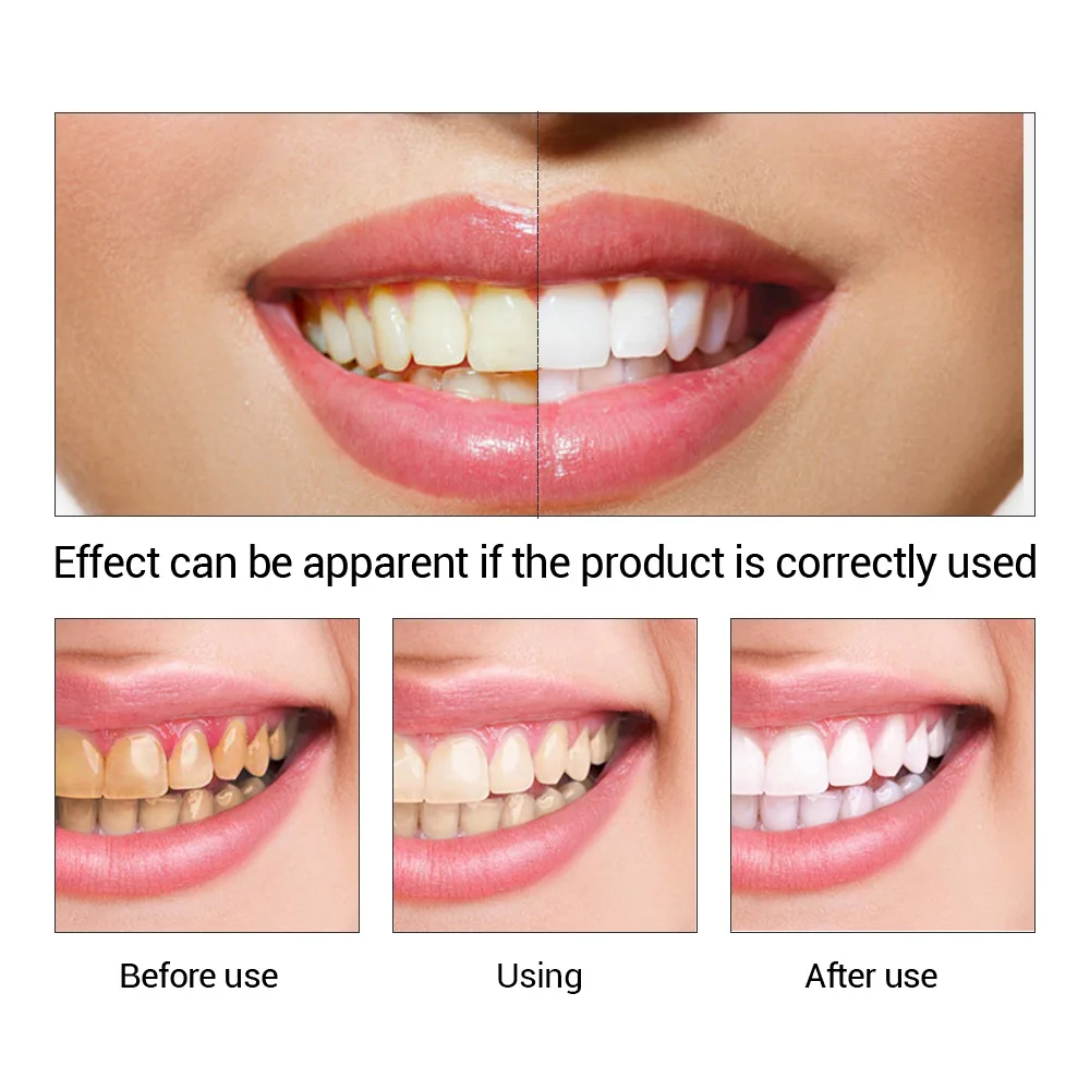 FTEENPLY Teeth Whitening Essen - Teeth Whitening Street 评论和价格