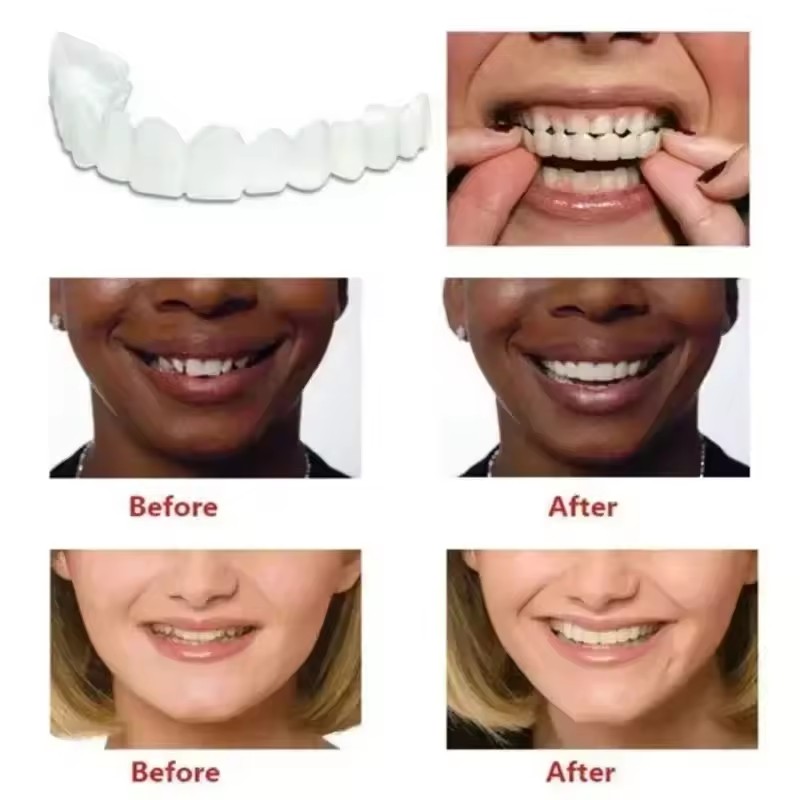 Teeth Veneers Whitening Dentur - Teeth Whitening Session 评论和价格