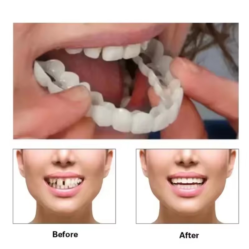 Teeth Veneers Whitening Dentur - Teeth Whitening Session 评论和价格